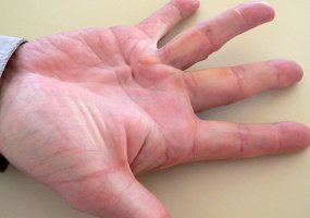 Doença de Dupuytren 